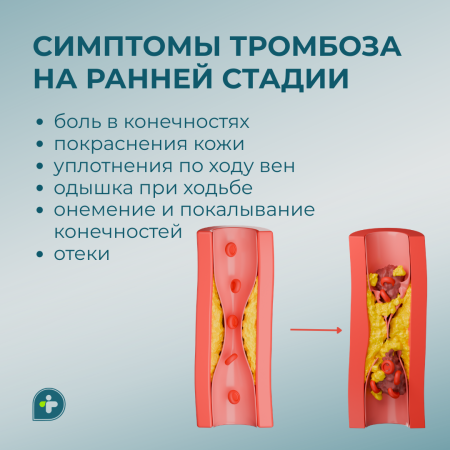 ТРОМБОЗ — ТИХИЙ ВРАГ ВАШЕГО ОРГАНИЗМА