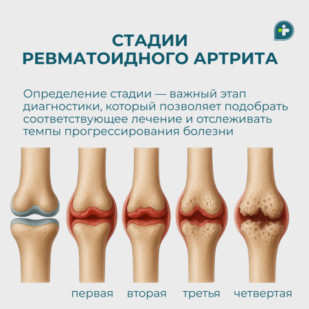 2 февраля — Всемирный день осведомленности о ревматоидном артрите